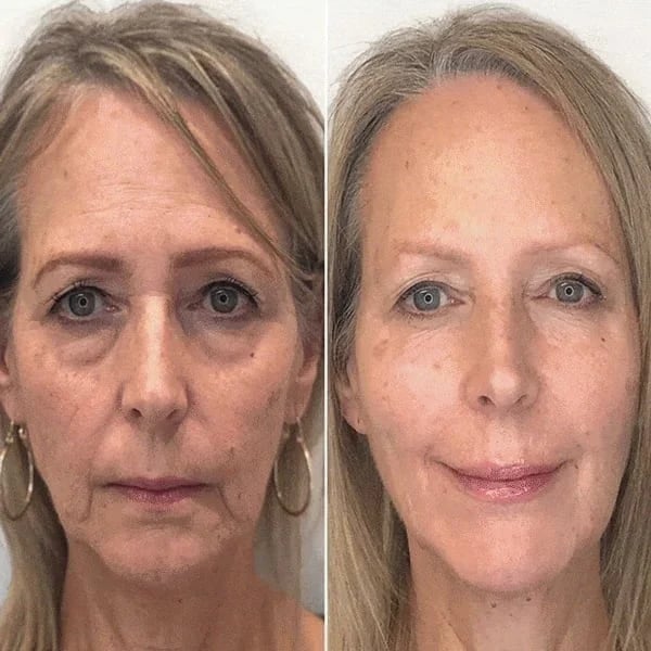 Last Day Promotion 49% OFF - š„Botox Face Serum