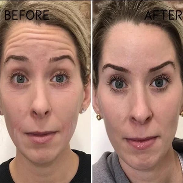 Last Day Promotion 49% OFF - š„Botox Face Serum