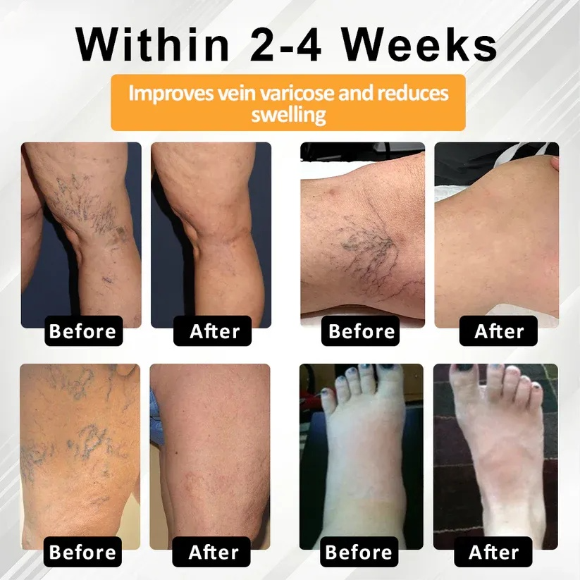 ODEIUN® MicroSting Bee Vein Ease Patches
