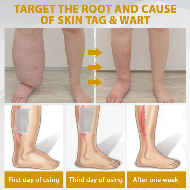 ODEIUN® MicroSting Bee Vein Ease Patches