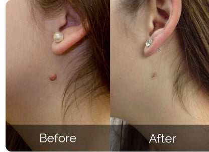🔥[Official Brand Store] JEREMYTIS™Skin Tag Removal Kit